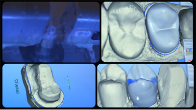 dental crowns at Katy dental office