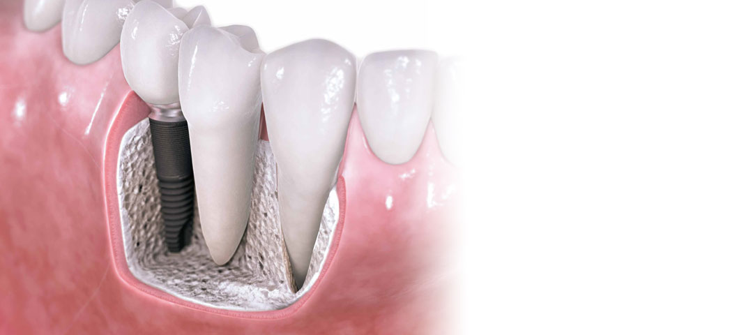 Dental implants are often the best option when it comes to replacing teeth.