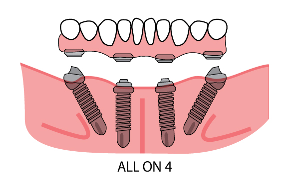 all-on-4-patient-1-2